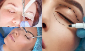 Göz Kapağı Ameliyatı Nedir ve Kimler İçin Uygundur?