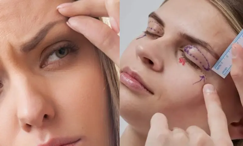 gozkapağıameliyatı-2-li-1